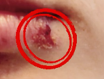 嘴角生瘡，唇瘡如何快速治療
