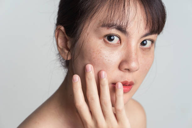 黑色素沉澱